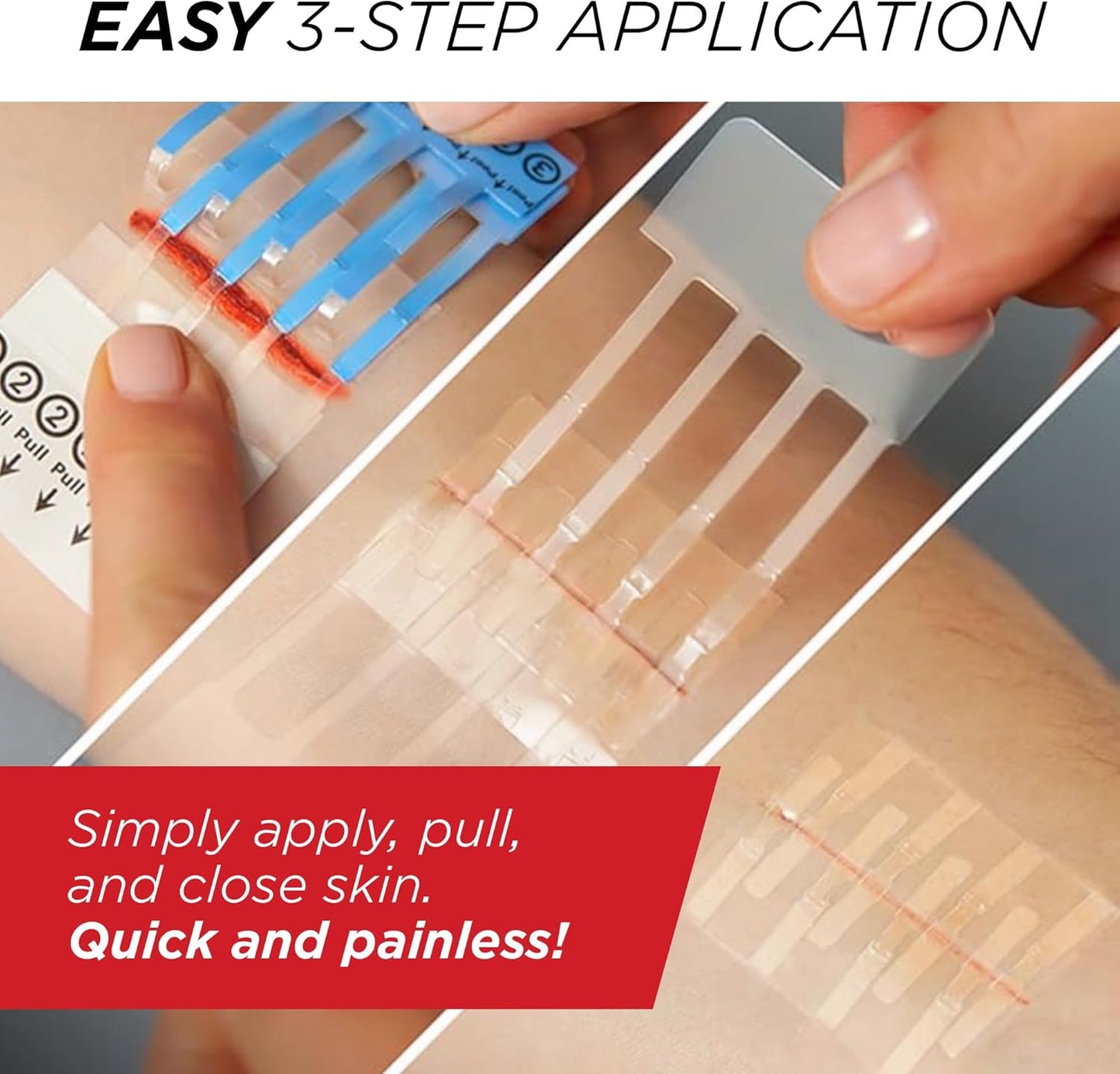 Emergency Laceration Closures